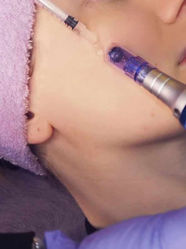 dermapen tratamiento