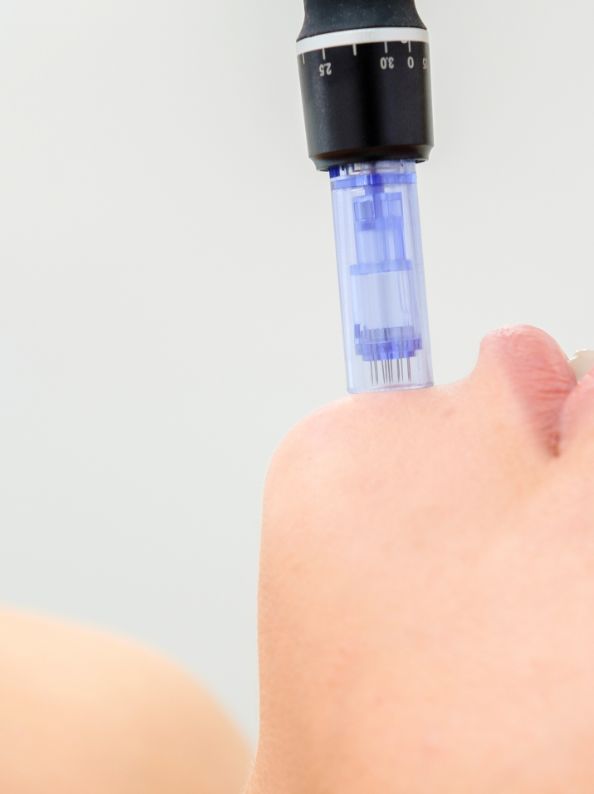 dermapen estetica avanzada