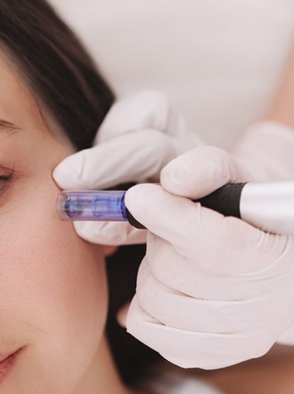 dermapen madrid tratamiento