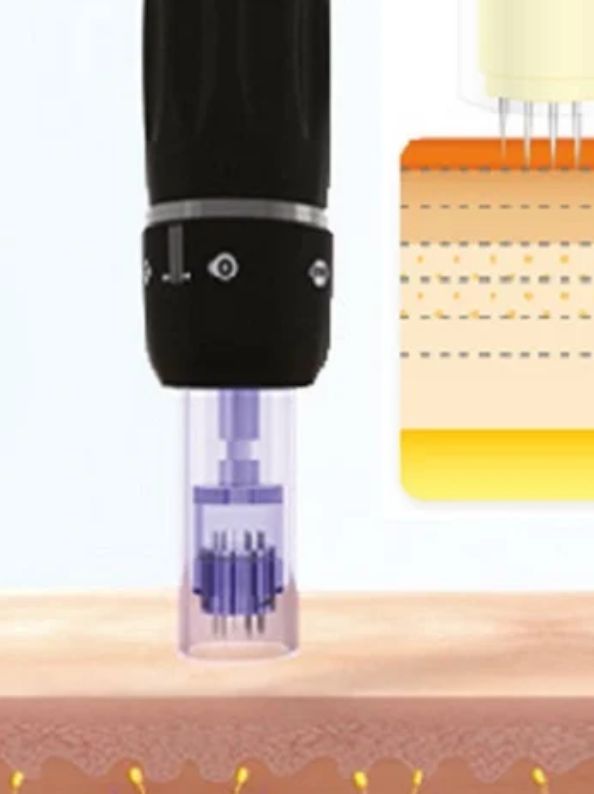 dermapen tratamiento madrid belleza