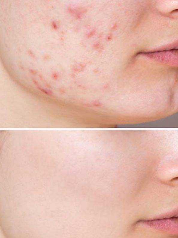 dermapen tratamiento madrid belleza