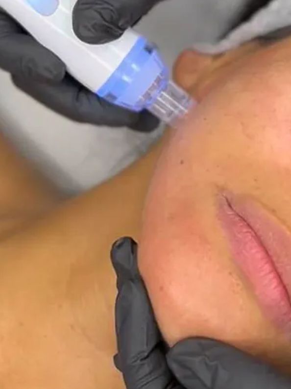 hydrafacial madrid belleza avanzada